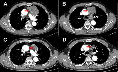 STK11 loss and SMARCB1 deficiency mutation in a dedifferentiated lung cancer patient present response to neo-adjuvant treatment with pembrolizumab and platinum doublet: A case report